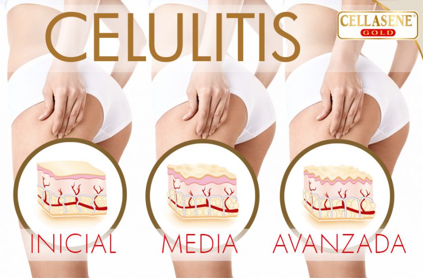 ¿Sabés qué tipo de celulitis tenés?